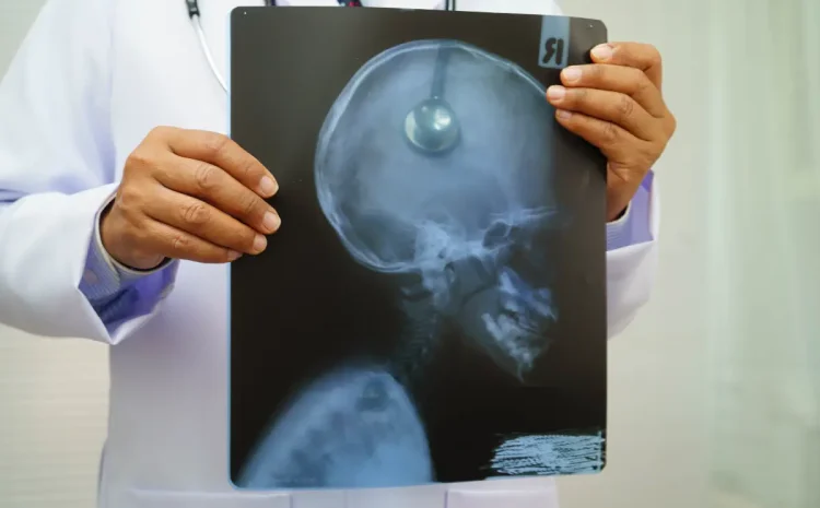 Is Sudden Vision Loss a Sign of a Brain Tumor?