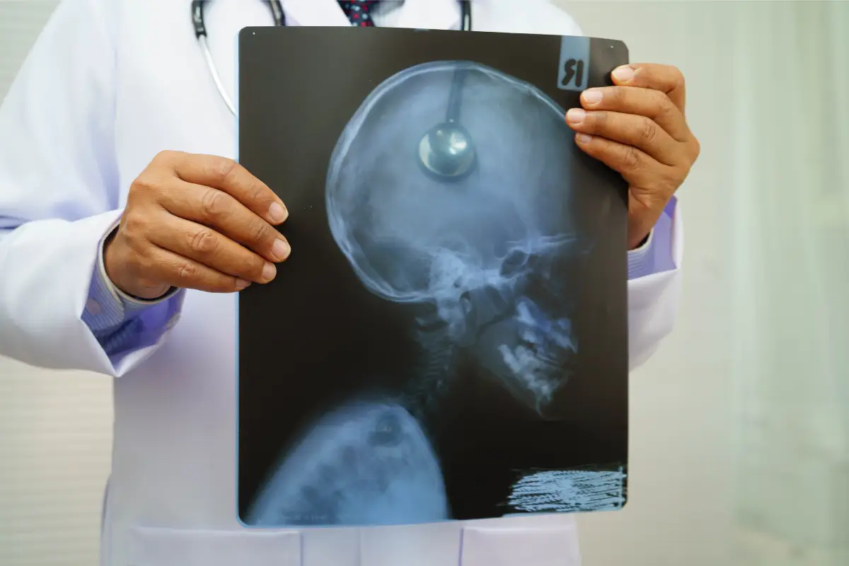 Brain Tumor Surgery In Mumbai